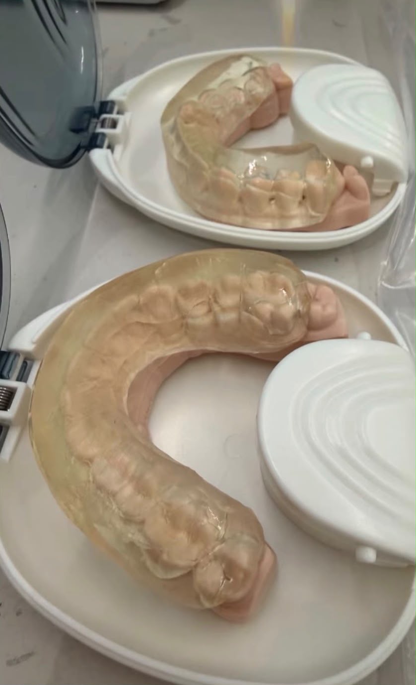Guard or Diagnose? Why Teeth Grinding Deserves a Question Before a Night Guard