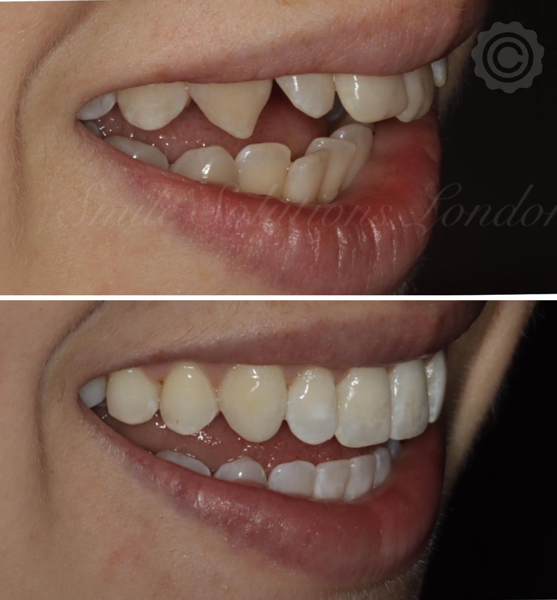 orthodontics vs veneers